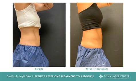 coolsculpting results after 3 months.